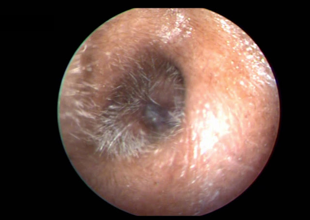 التهاب-خبيث-للأذن-الوسطى