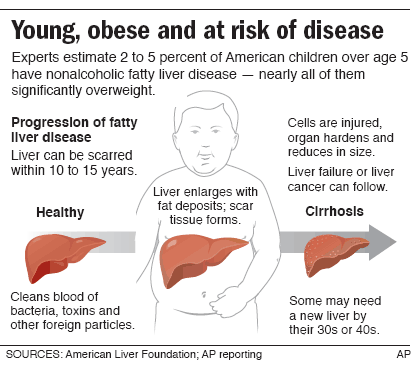 liver fatty children disease teens damage obesity risk health heavy fat varices symptoms year who cirrhosis reverse end severe failure