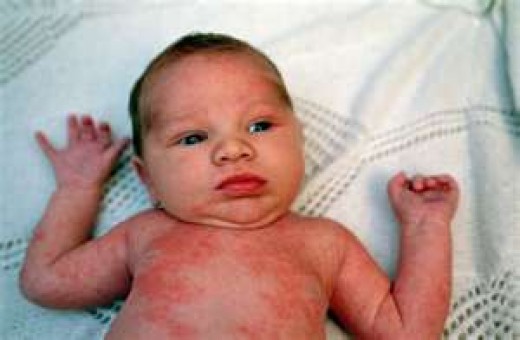 Baby Acne Cure And Treatment Baby Eczema Pictures What Looks Like