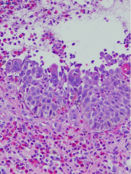Sialometaplasia necrosante pdf to jpg