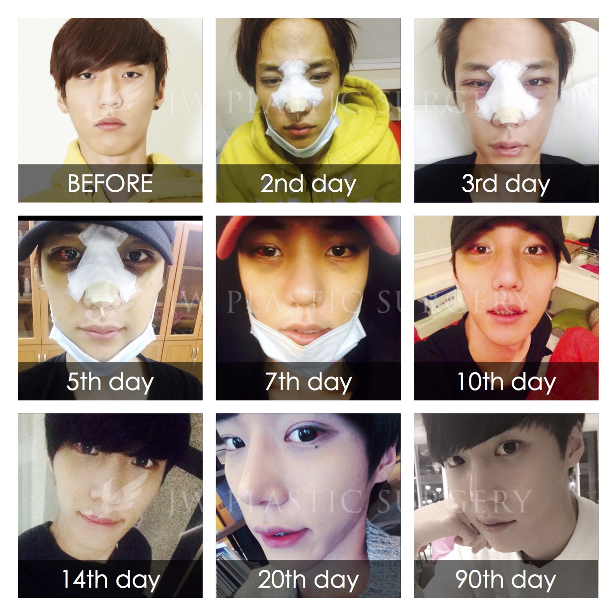 [JW Plastic Surgery Korea] Got Eye Surgery and Nose Surgery from Seoul
