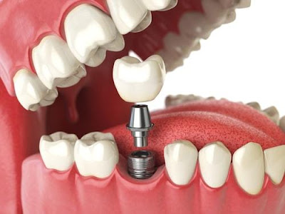 Trường Hợp Nào Nên Cấy Ghép Implant?