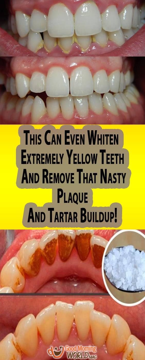 This Can Even Whiten Extremely Yellow Teeth And Remove That Nasty