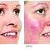 Redness on Face ( Rosacea ) Treatment at Home