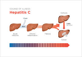 Penyakit Hepatitis C http://www.udan.name Penyakit Hepatitis C http://www.udan.name