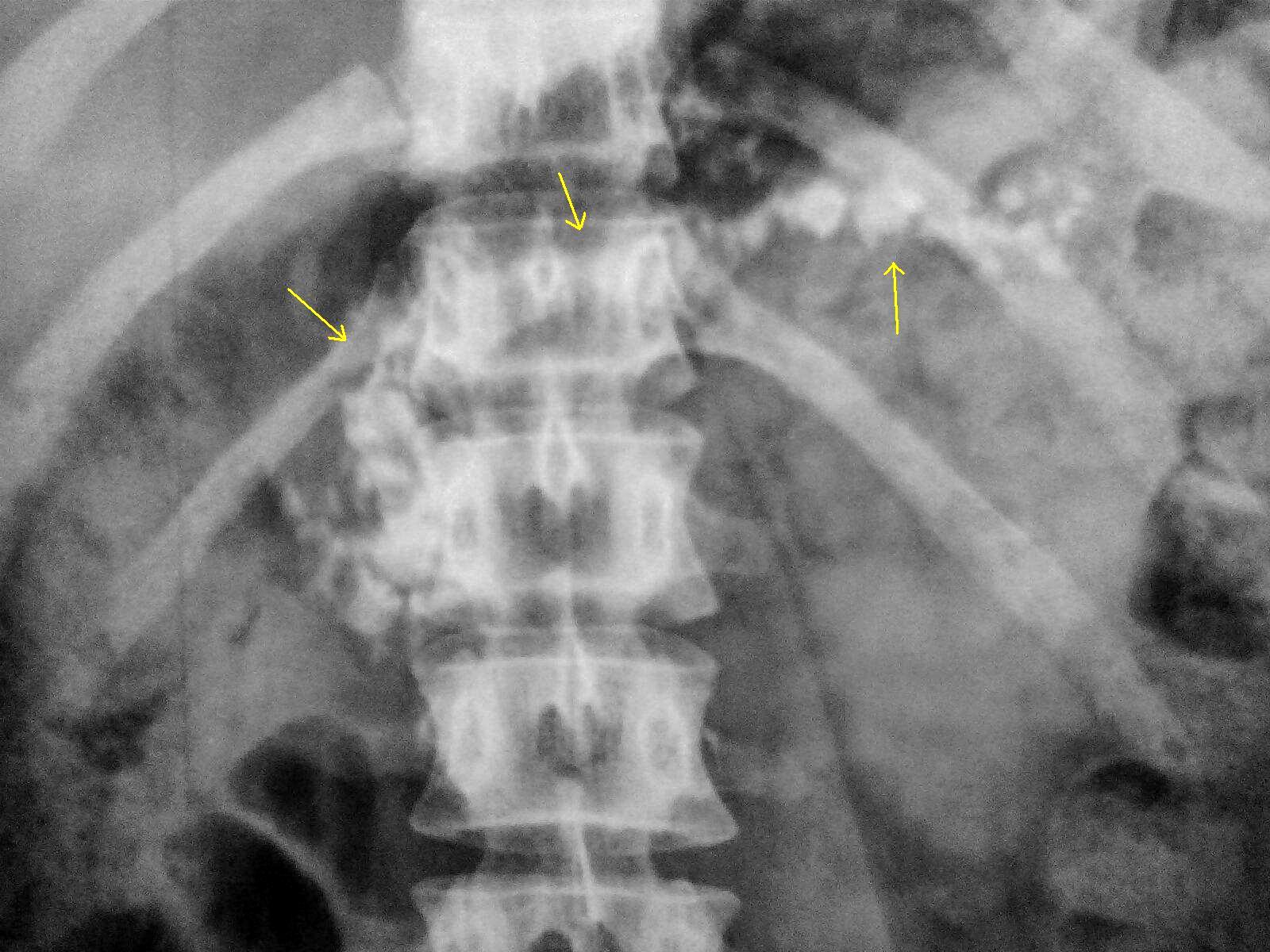 What Causes Calcium Deposits In Pancreas at Mike Boldt blog