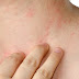 Dermatite atópica já atinge até 15% da população