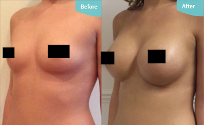 Antes e Depois Mamoplastia de Aumento Antes e Depois Mamoplastia de Aumento