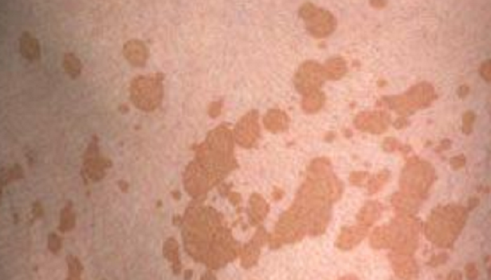 kleienpilzflechte rücken bilder