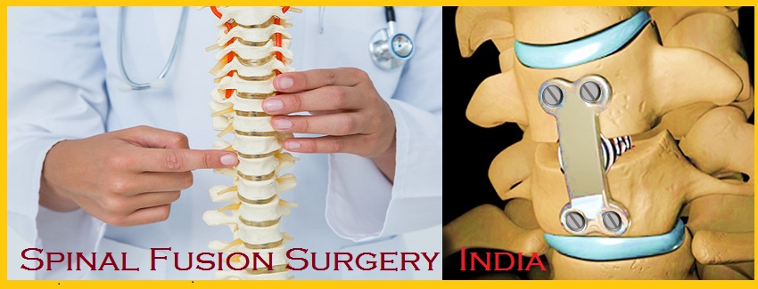 Neck fusion surgery cost