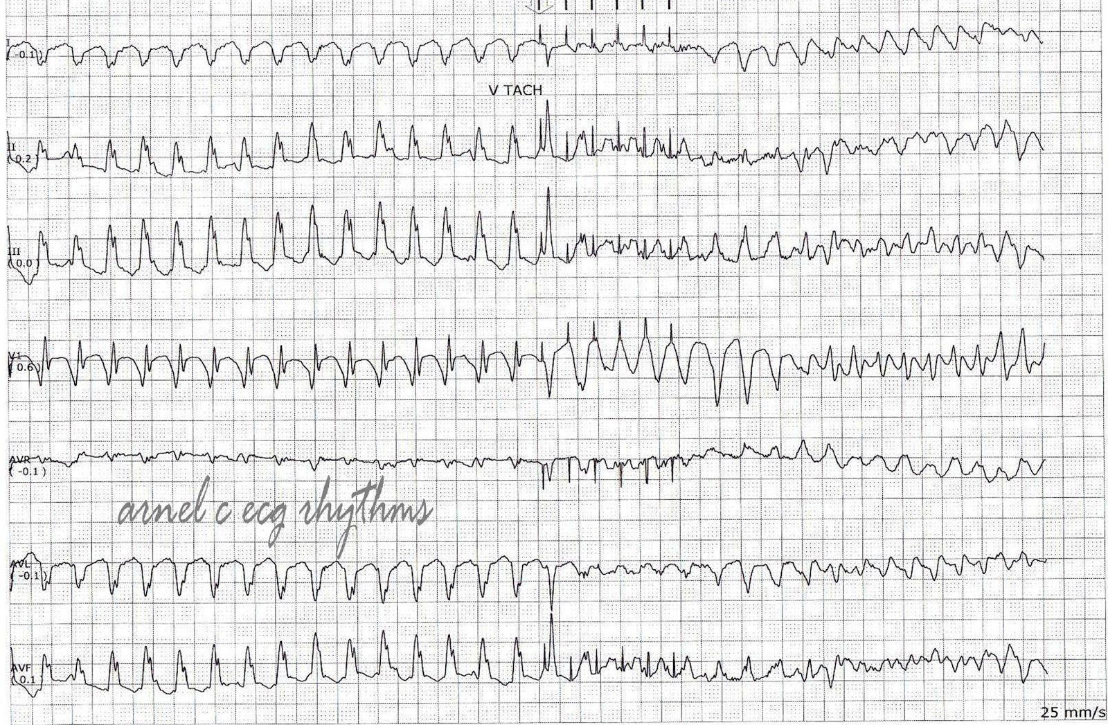 ECG Rhythms Antitachycardia pacing + AICD firing