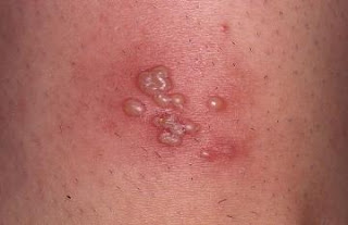 Foto Ini Obat Ampuh Penyakit dompo, cacar atau herpes yang paling tepat