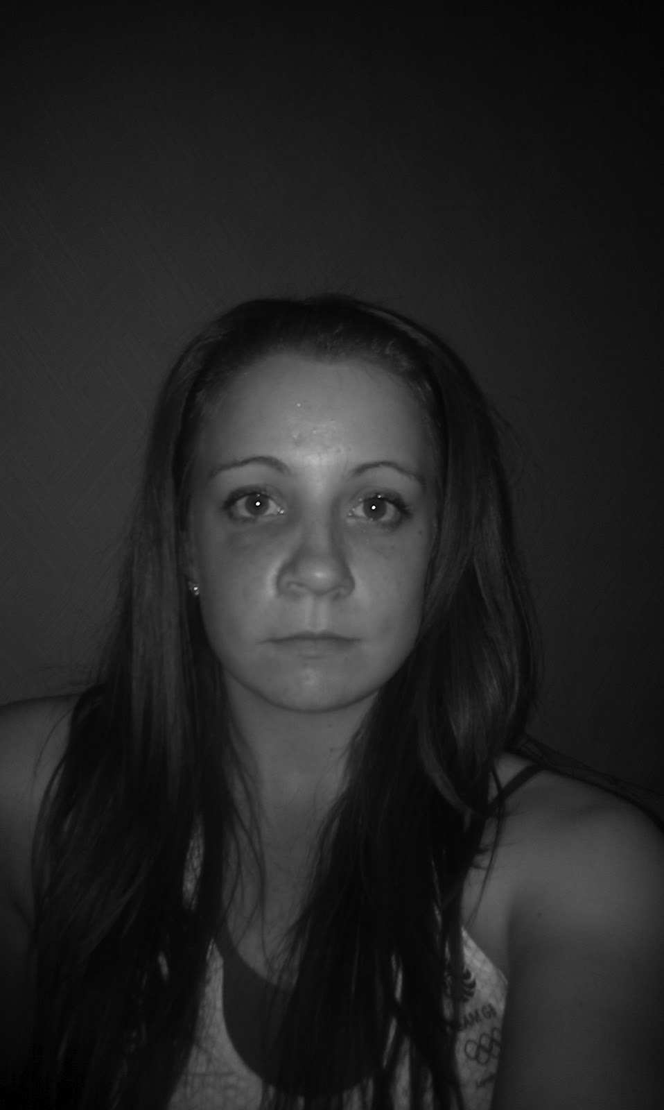 EmBracing Upper and Lower Jaw Surgery Day 406 Fat Face Returns......