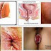 Obat Bebas Wasir Bengkak Tanpa Operasi thumbnail