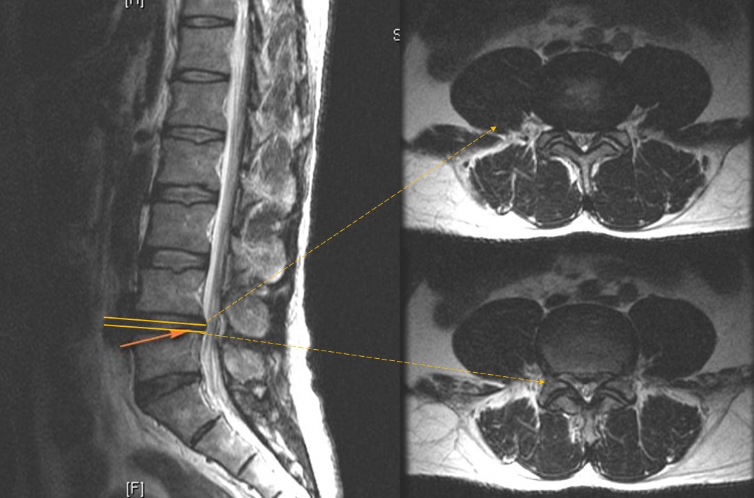 脊椎手術 鄞宗誠醫師 (TsungCheng Yin , M.D.) 12月 2016