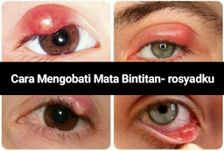 Cara Mengobati Mata Bintitan Cara Mengobati Mata Bintitan