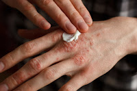 Obat gatal tradisional yang ampuh atasin gatal gatal pada sela jari