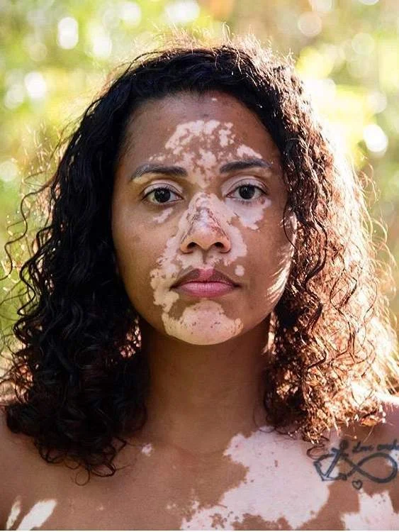 mujeres bellas con vitiligo