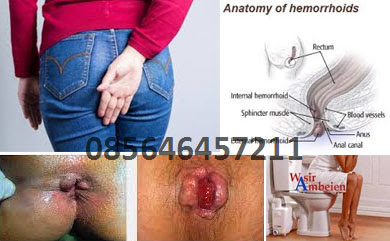 Sakit Ambeien Obat nya Apa Sakit Ambeien Obat nya Apa