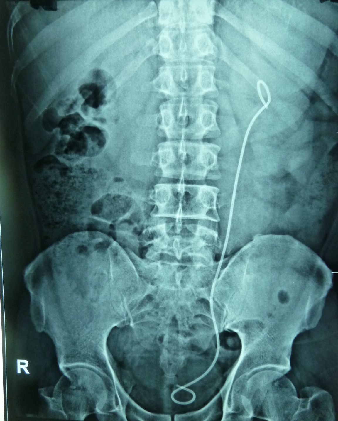 Ramayya Pramila Urology Hospital Partial staghorn kidney stone removed