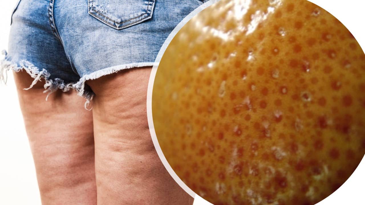 eliminar celulitis de gluteos