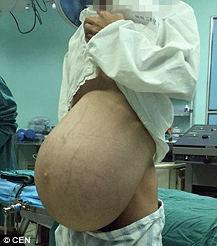 Pria Cina Ini Tampak Hamil Dan Memiliki Tumor Besar Di Perutnya Pria Cina Ini Tampak Hamil Dan Memiliki Tumor Besar Di Perutnya