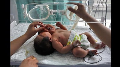 nace bebe con dos cabezas en china fotos