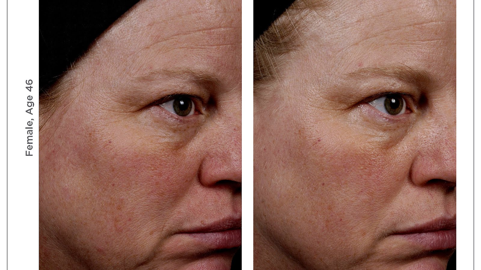 Retinol Effects On Skin Effect Choices