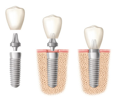 Thông tin cơ bản về cấy ghép implant