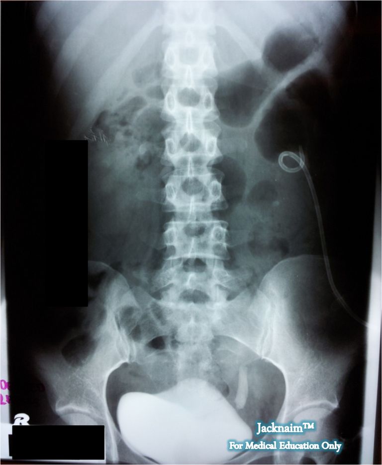 My Medical Notes Intravenous Urogram Non Functioning Left Kidney