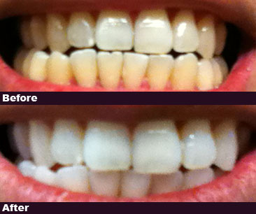 advanced teeth whitening strips használata online