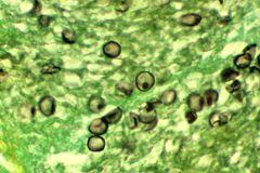 kista Pneumocystis jirovecii dalam jaringan kista Pneumocystis jirovecii dalam jaringan