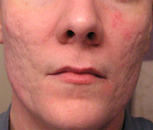 Deep facial scars - mp4 video scars Deep facial