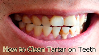 How to Clean Tartar on Teeth