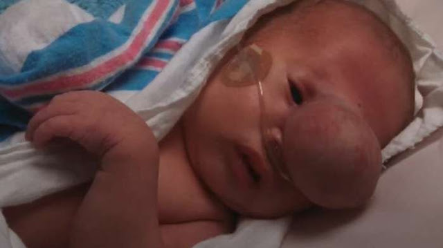 Tak Kuasa Menahan Tangis, Bayi Ini Harus Ditangani 22 Dokter Untuk Operasi Benjolan Pada Wajah