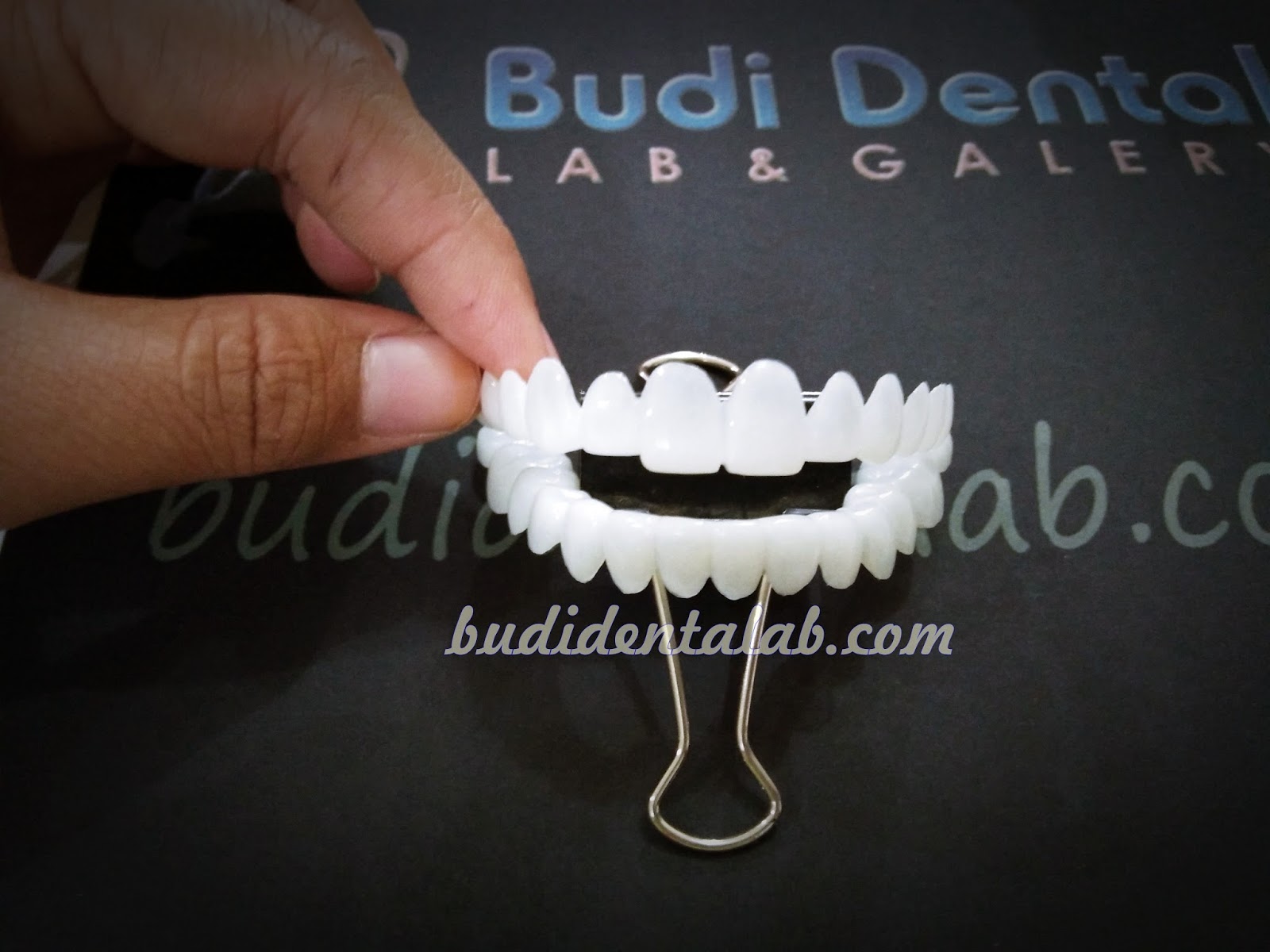 Removable Veneer / Snap On Teeth Budi Dental