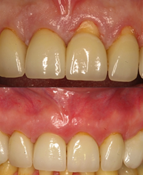 Dentist Invents New Treatment To Slide Receding Gums Back Down