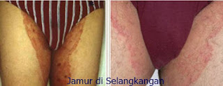 Obat Gatal Jamur pada Selangkangan di Apotek Umum