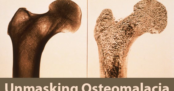 Osteomalacia causes, pathogenesis, diagnosis and treatment