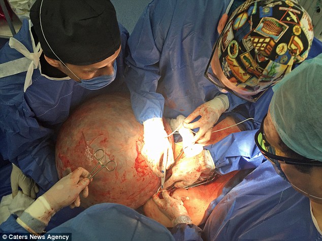 24-Year-Old Woman Has the World's Biggest Cyst Removed After Her Organs Were Crushed 24-Year-Old Woman Has the World's Biggest Cyst Removed After Her Organs Were Crushed