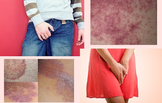Image Jual obat gatal selangkangan bentol berair