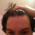 What Is Acne