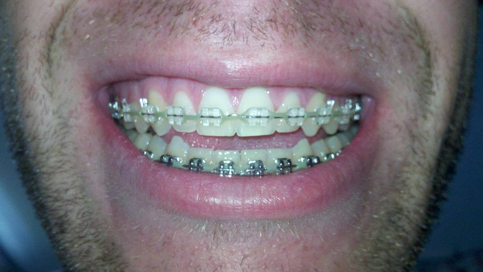 Braces/Open Bite Surgery New Pricing Info and Pics