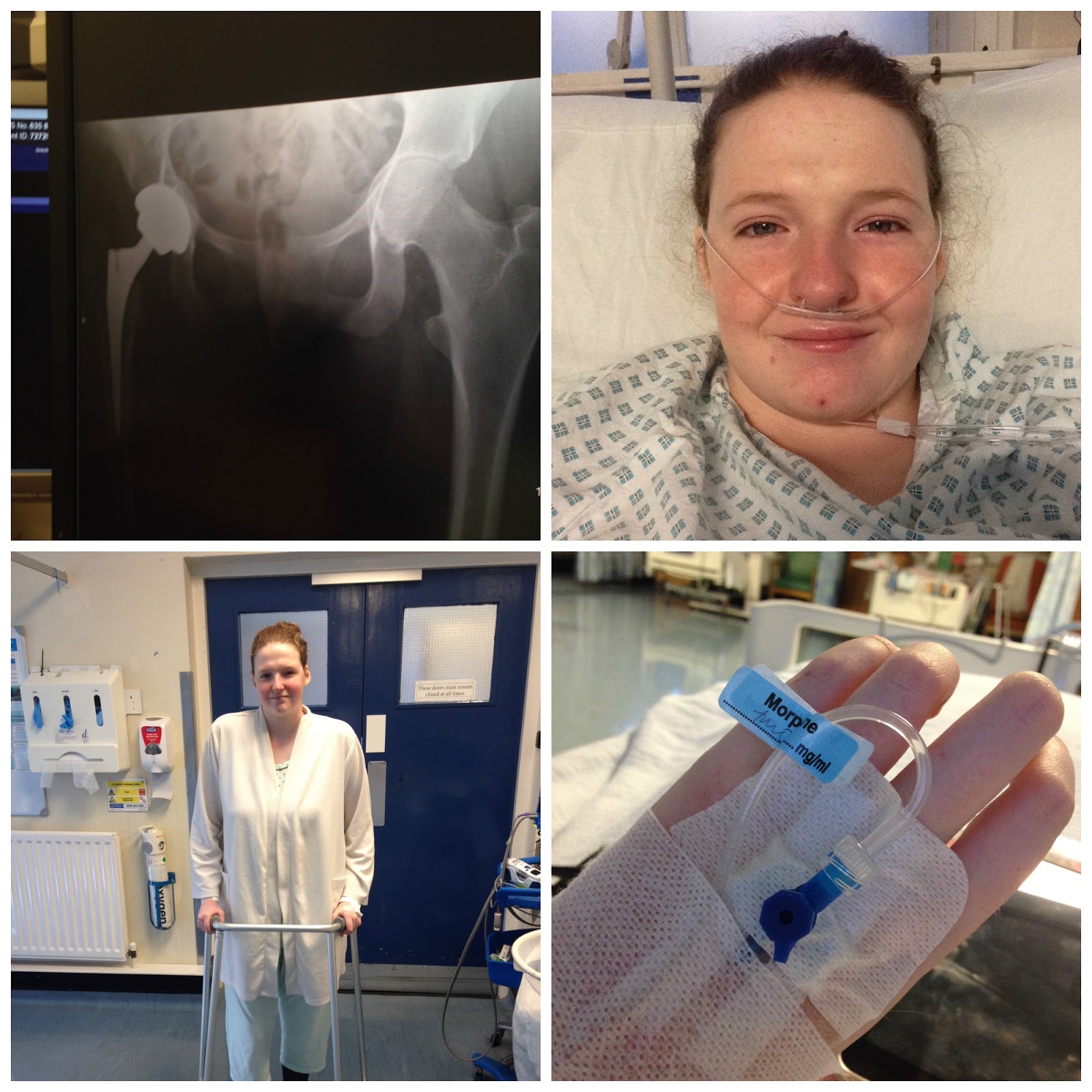 Hip Replacement 6 Months Post Op Shona Louise