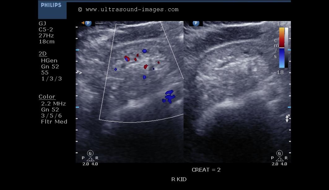 cochinblogs: Ultrasound imaging in chronic renal failure or chronic