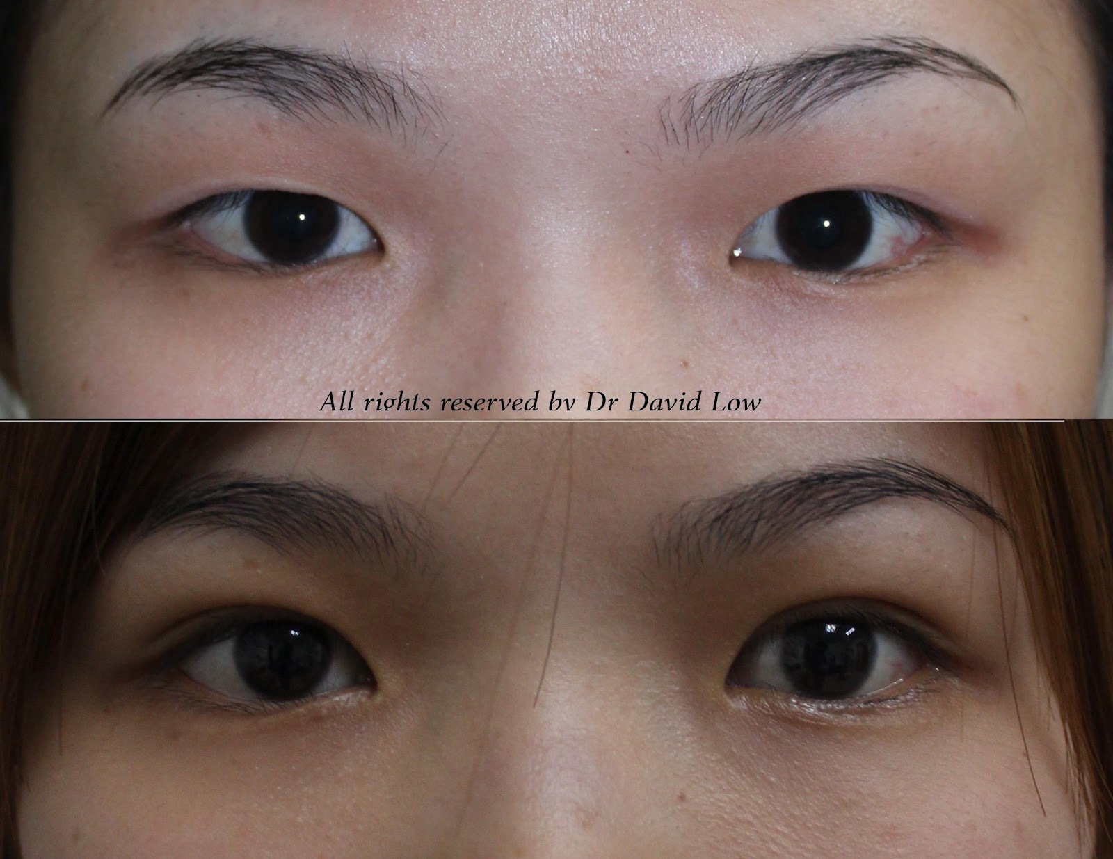 The Art & Science of Beauty The Durable Noncutting Double Eyelid