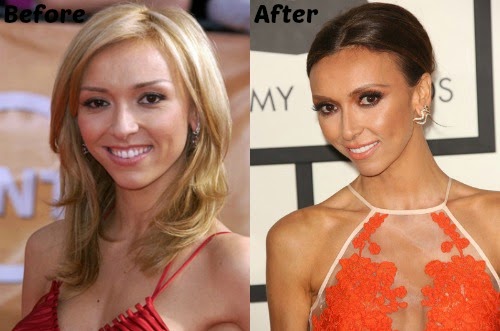 Giuliana Rancic Plastic Surgery Anorexic, Diet Before and ...