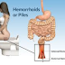 Cara Mengobati Penyakit Wasir (Hemoroid) Akut thumbnail