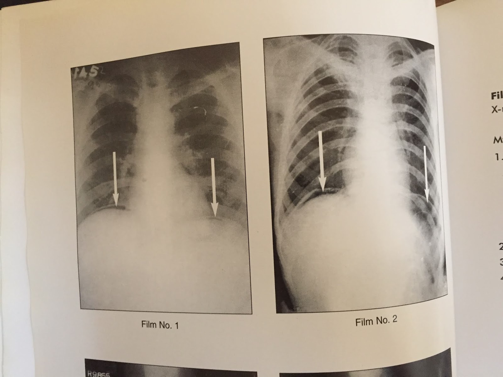 XRAY FREE GAS UNDER DIAPHRAGM