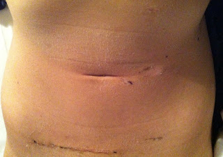 kidney donor organ donation surgery recovery scar